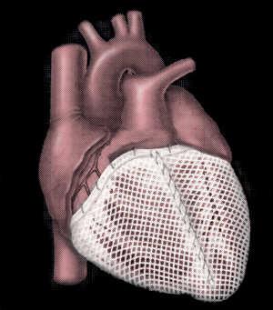 ACORN Novel Mechanical Anti-remodeling Therapies in Heart Failure: Cardiac Support Devices HeartNet PEERLESS HF Trial Multicenter RCT of 217 patients with chronic advanced HF despite max med/device