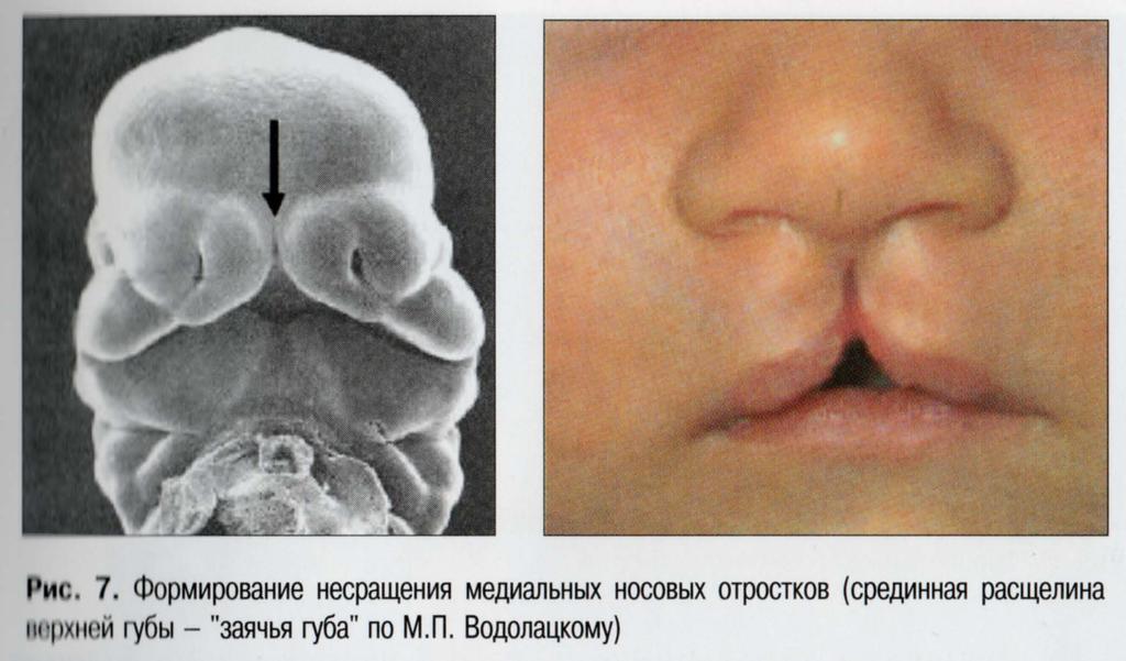 Median cleft lip: results from failure of the medial