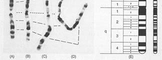 Chromosome - detail TYPES OF ANOMALIES Aneuploidy (extra or