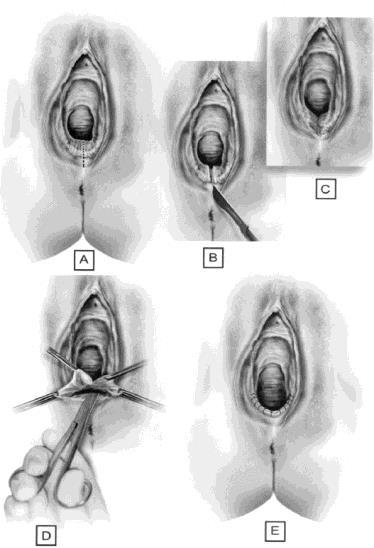 Vaginal stricture formation