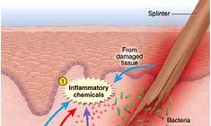 Hallmarks of inflammation: Redness, heat, pain, swelling, and loss