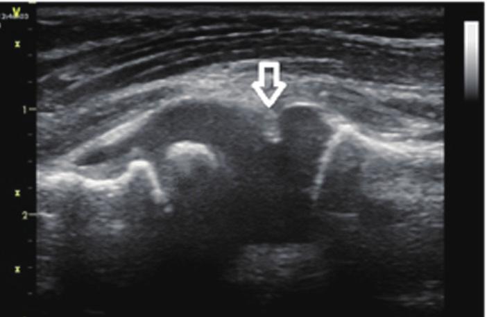 Ultrasonography was performed using a high-resolution 14-MHz linear probe on a GE S5 ultrasound machine (GE Healthcare, Milwaukee, WI, USA).