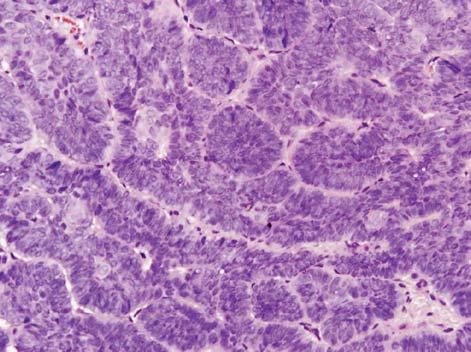 Basal Cell Ameloblastoma: Report of a Rare Case with Review of Literature is a benign odontogenic tumour that tends to arise from odontogenic epithelium.