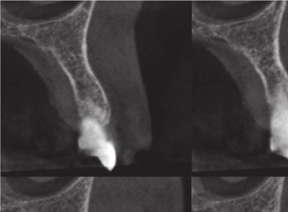 4 Case Reports in Dentistry Figure 8: CT 10 months after biopsy. Figure 9: Palate clinical view 1 year after biopsy. purpose of detecting any recurrence which could possibly develop in the future.