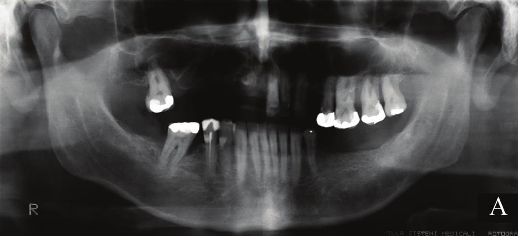 2 Figure 1: Panoramic radiographs of the patient. Taken at the first visit.