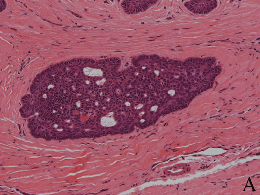3 (c) Figure 3: Cystic formations in an ameloblastomatous nest (H&E, 20x); squamous metaplasia seen in an ameloblastomatous nest (H&E, 20x).