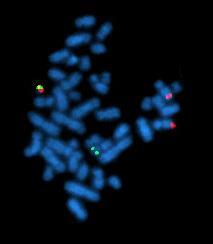 Philadelphia Chromosome 1959 Chromosome 9-22 translocation, specific to Chronic Myeloid Leukemia Results in the fusion