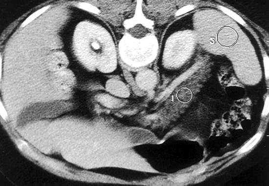 0001 Figure 1. Multidetector computed tomography scan: edema of the pancreas.