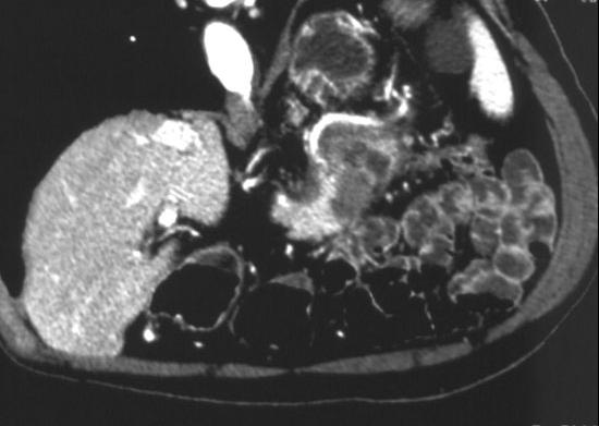 well-visualized Figure 3. Multidetector computed tomography scan: fluid collections. after 48-72 hours from the onset of acute pancreatitis.