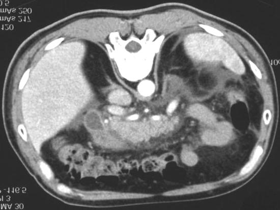 Figure 5. Multidetector computed tomography scan: peripancreatic fat necrosis. Figure 8. Multidetector computed tomography scan: link between pancreatic pseudocyst and the Wirsung duct. Figure 6.