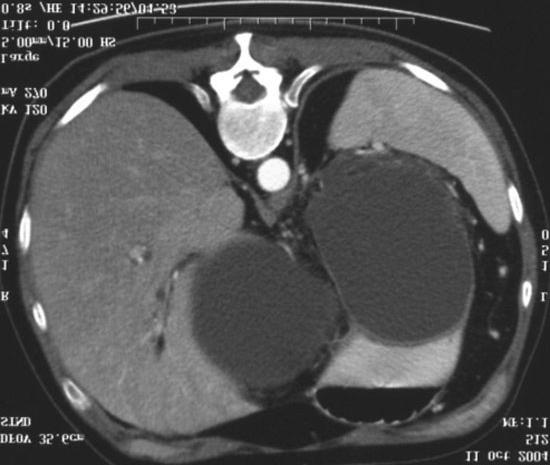 Furthermore, we can also obtain information about pleural and pulmonary alterations. Thus, a new CT severity index has been proposed by Mortele et al. [6].