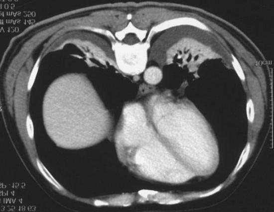 Figure 9. Multidetector computed tomography scan: pleural effusion.