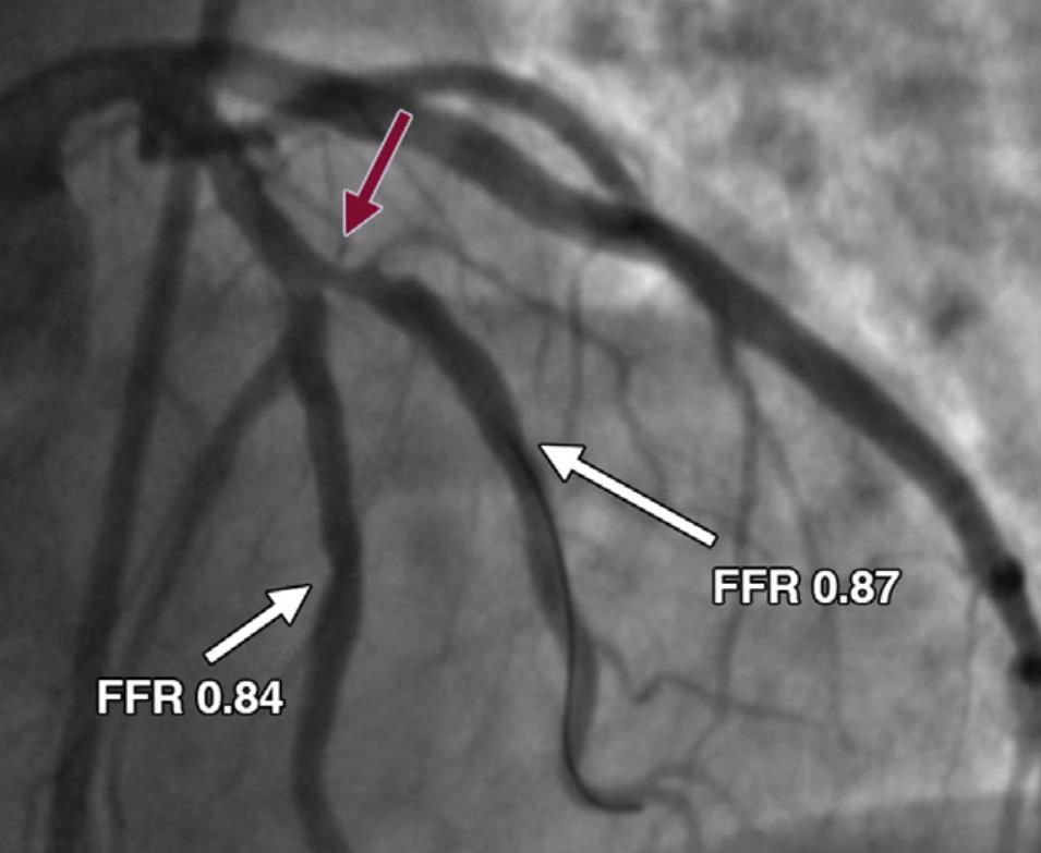 Influence of Coronary Calcification on