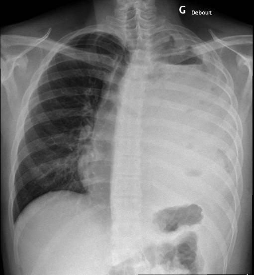 Imaging A chest X-ray and a thoracic CT-scan (not available) show a severe left pleural effusion,