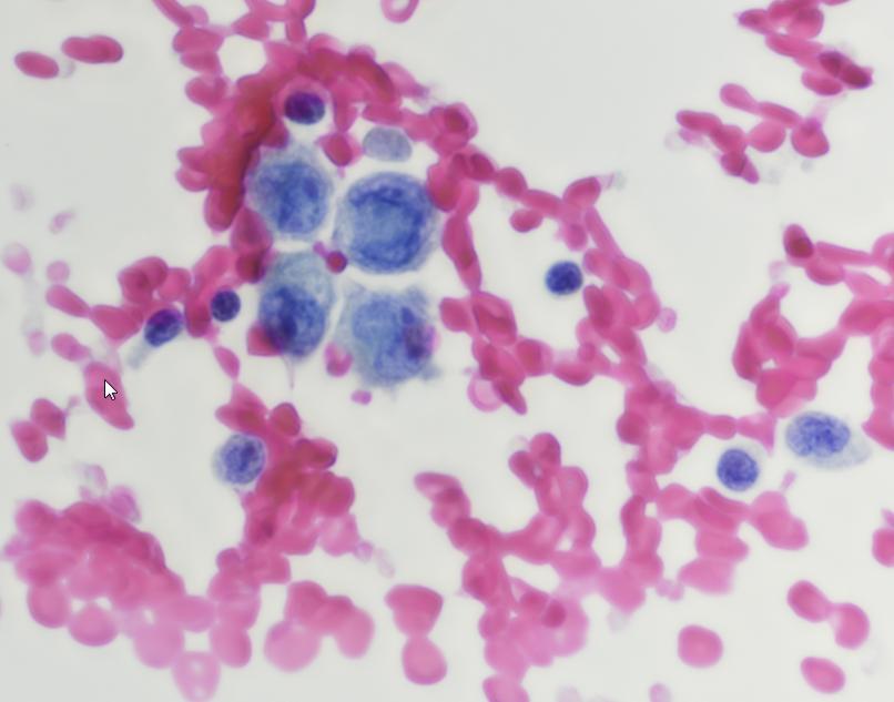 Pleural effusion cytology A chest drain was installed with a removal of 6 liters of liquid.
