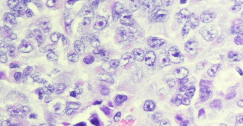 Poorly cohesive sheets Large atypical cells, with enlarged nuclei and vesicular