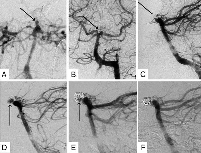 1760 Stroke May 2009 Figure 2. Angiography series of a 52-year-old man with recurrent SAH 23 months after coiling of a basilar tip aneurysm. A, Small ruptured basilar tip aneurysm (arrow).