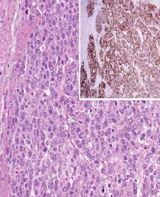 neuro-endocrine carcinomas of small cell type synaptophysin > chromogranin express TTF-1 some are