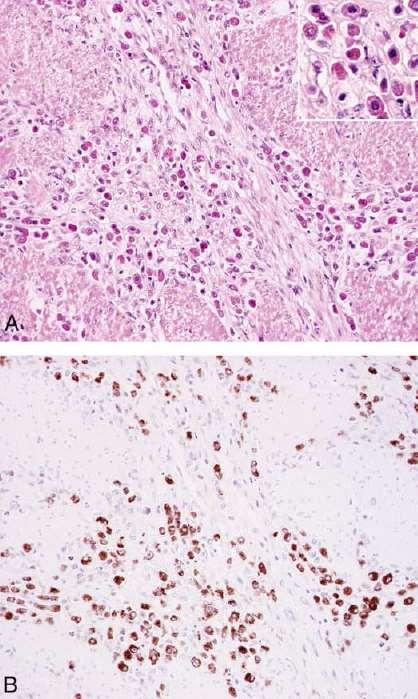 Sporadic (type III) gastric NETs typically G2 tumours but some are G3 neuro-endocrine carcinomas usually large cell type vesicular nuclei, large nucleoli