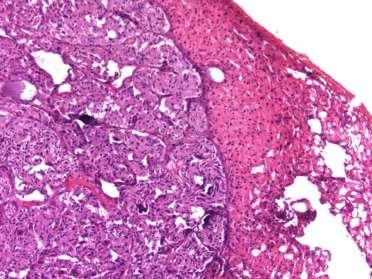 Duodenal D-cell NETs tumours of low grade malignancy lymph node metastasis in 25% (usually