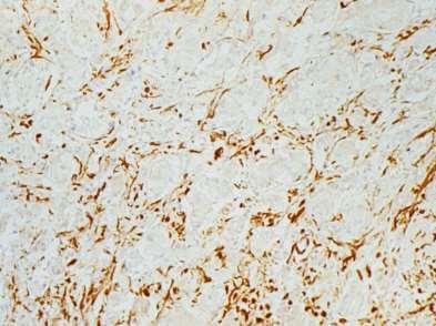 Gangliocytic paraganglioma spindle cells