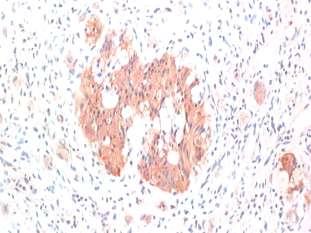 Gangliocytic paraganglioma spindle cells epithelioid cells nests and ribbons variably