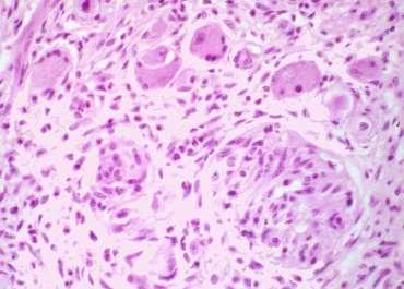 Gangliocytic paraganglioma spindle cells epithelioid cells ganglion cells typical ganglion