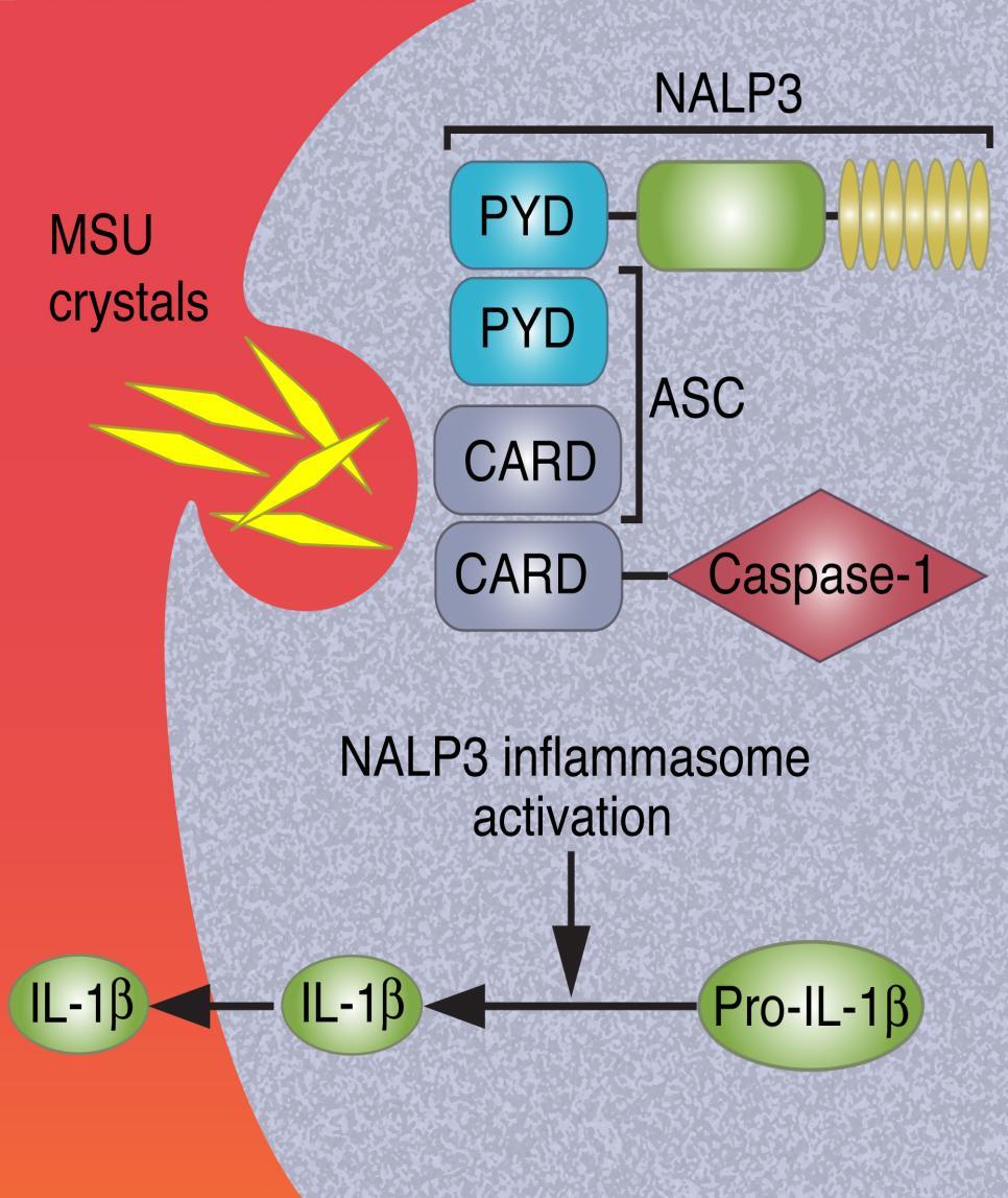 Gout: Evidence for Role of IL-1 (Continued) Monosodium urate crystals internalized by monocytes activate the NLRP3 inflammasome which leads to the processing and release