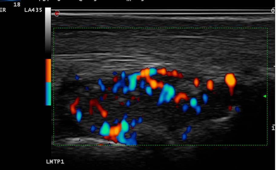 Metatarsal head Figure 2 Acute visit examination of 1st metatarsophalangeal joint showing gray-scale and power Doppler grade 3 but the joint was not tender or swollen 4.2.2. Intercritical visit During the intercritical visit, the median number clinically active joint count was 0 (IQR 0-0).