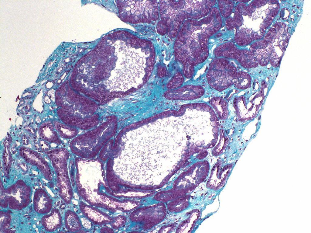 Chronic tubulointerstitial nephropathy with diffuse interstitial fibrosis,