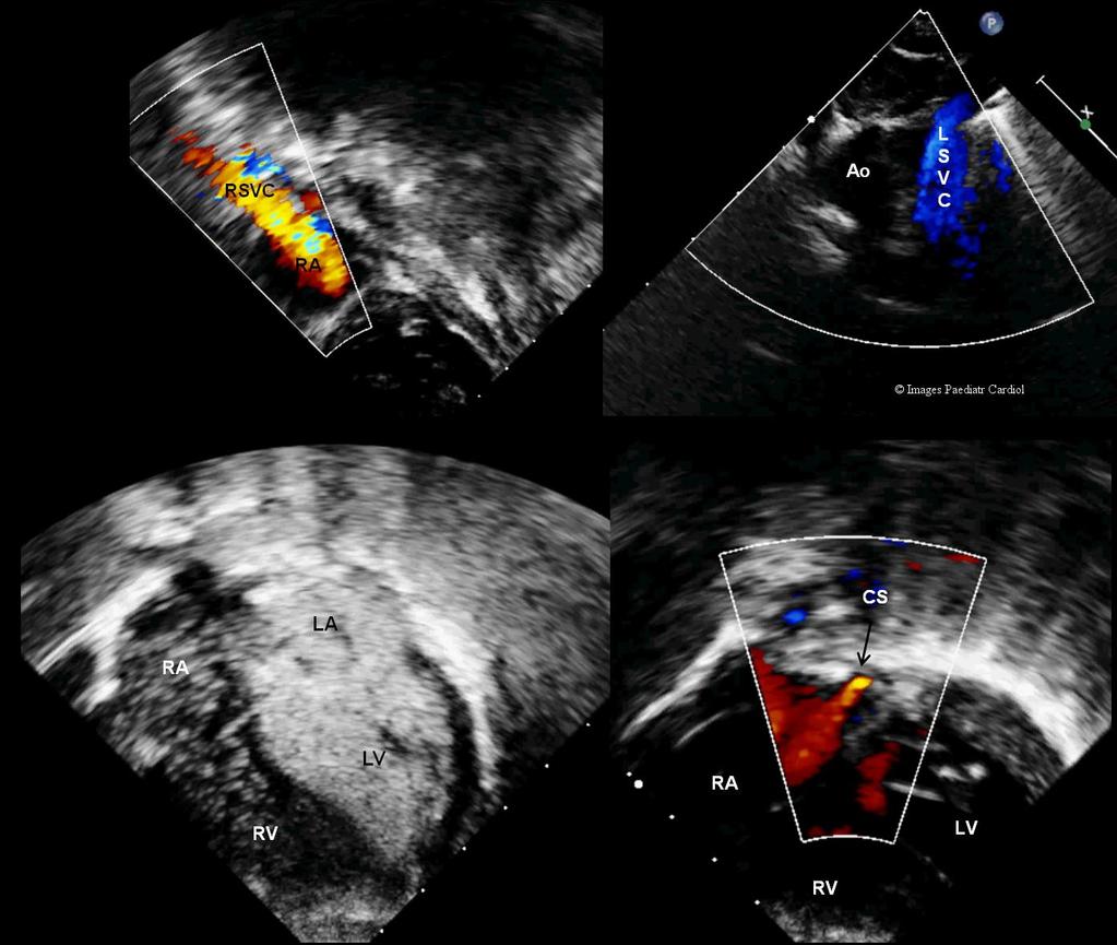 Figure 2: Echocardiography evaluation a. Subcostal sagittal view showing right superior vena cava (RSVC) to right atrium (RA) (Top left) b.