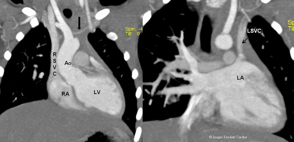 Figure 3: Computed tomographic angiogram a. Right SVC connecting right atrium. There was a small connecting vein between the right and left SVCs (marked by dark arrow). b. Left SVC connecting to roof of left atrium (instead of the coronary sinus).