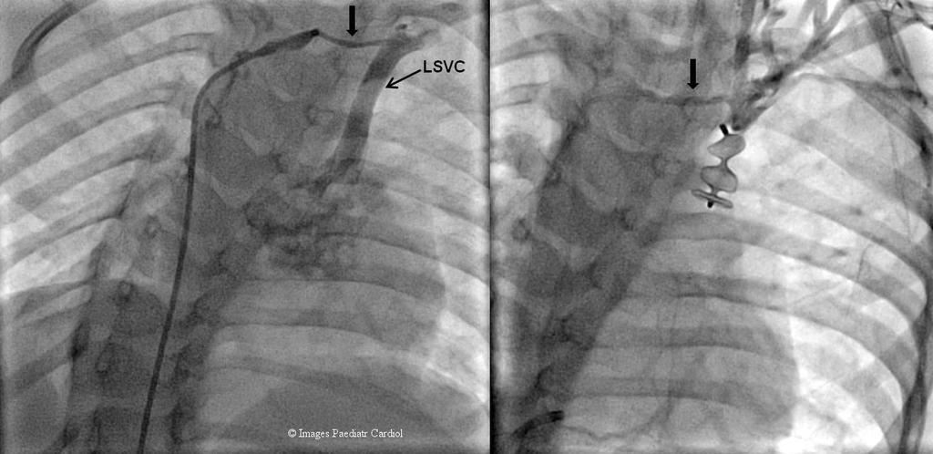 During cardiac catheterization, a. Injection in innominate vein showing LSVC connecting to left atrium. b. Amplatzer vascular plug deployed in left SVC.