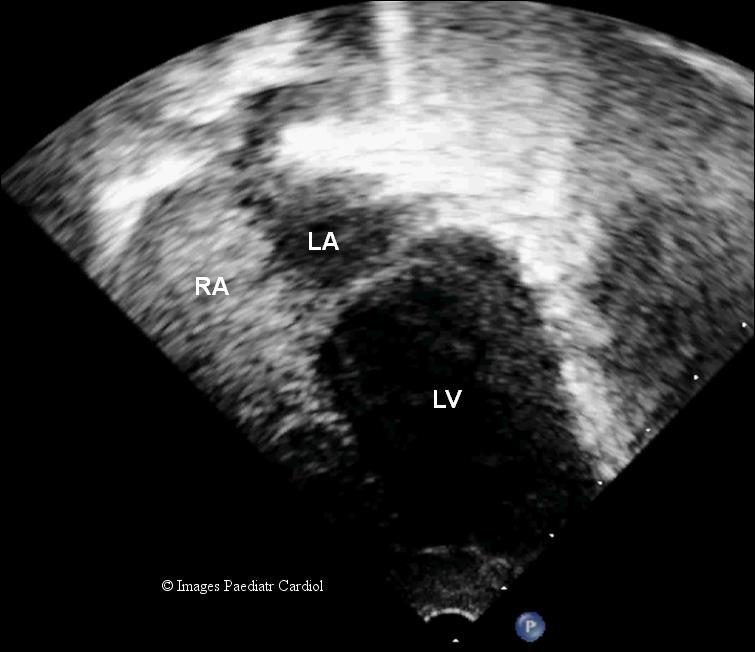 Figure 5: Contrast echocardiography with agitated saline from left arm after the procedure showed filling of right atrium and no evidence of contrast in left atrium.