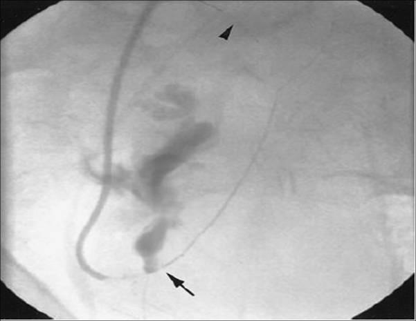 Inferior epigastric artery engaged with 6Fr