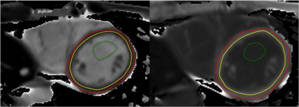 Kawel-Boehm et al. Journal of Cardiovascular Magnetic Resonance (2015) 17:29 Page 28 of 33 Figure 20 T1 maps pre- and post-contrast with left ventricular endocardial and epicardial contours.