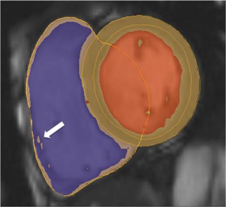 Kawel-Boehm et al. Journal of Cardiovascular Magnetic Resonance (2015) 17:29 Page 6 of 33 Figure 4 Example of RV contouring using a semiautomatic software.