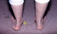 Introduction Acquired flat foot - common problem between 45-60 years Loss of