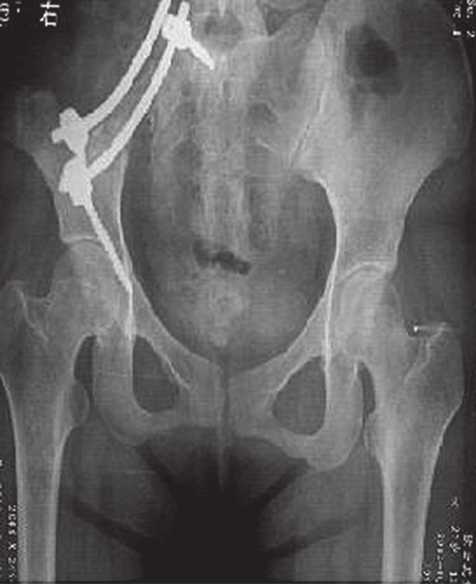 76 contemporary oncology A B Fig. 5. Radiological results of use of the pedicle screw-rod system Results The mean operative blood loss was 1337.