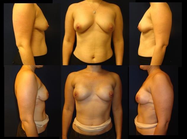 Bilateral prophylactic nipple sparing mastectomies BRCA mutation