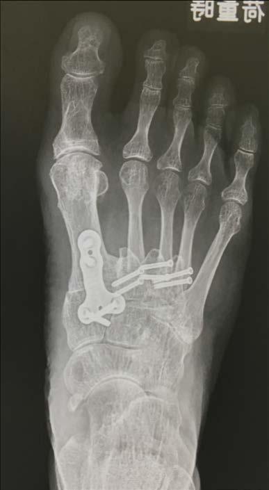 lesser toe deformity of transfer metatarsalgia.