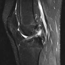 knee ACL graft