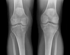 Post-op Radiographs ACL reconstruction with BTB allograft At 2