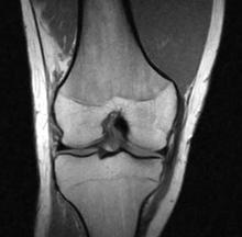 MRI MRI Read: Right knee partial ACL tear of posterolateral bundle No anteromedial bundle involvement No lateral or medial meniscus tears