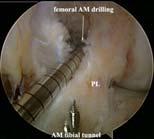 PL Bundle Augmentation Posterolateral Bundle Reconstruction With Anteromedial Bundle Remnant Preservation in ACL Tears: Clinical and MRI Evaluation of 39 Patients With 24 Month Follow-up