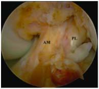 partial thickness ACL