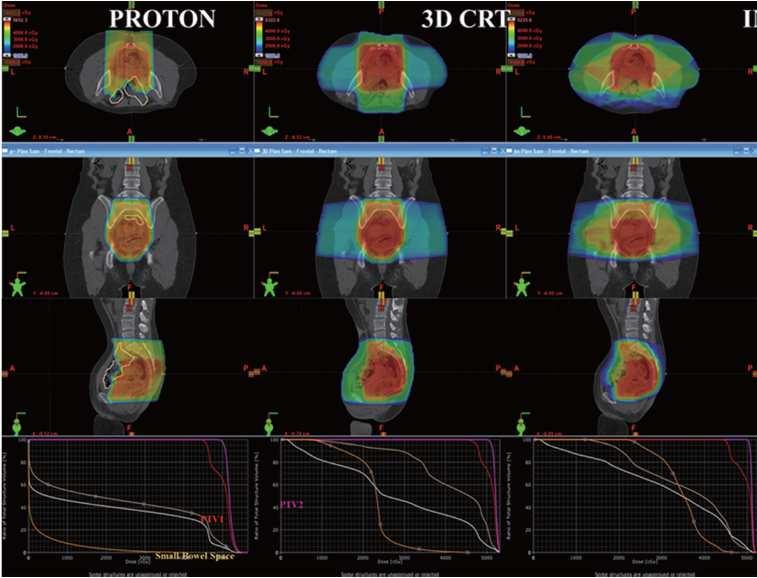 demonstrated in phase III photon trials Bone marrow-sparing pelvic proton therapy Comparison proton, 3D, and IMRT plans Background 30-40% of adult bone marrow is contained within the pelvis