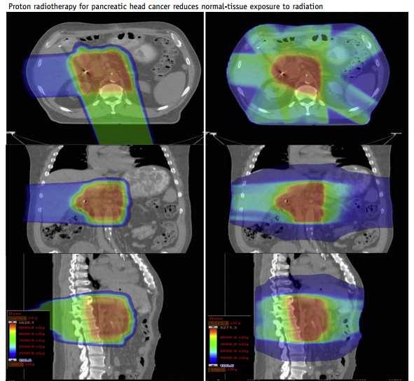 Improved ability to reduce radiation dose to normal tissues Small bowel