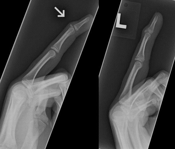 Problematic Pediatric Hand and Wrist Fractures. Goodell, Parker; Bauer, Andrea JBJS Reviews. 4(5), May 17, 2016. DOI