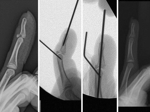 Fixation of an adolescent bony mallet fracture using Ishiguro extension block technique. Kate W. Nellans, Kevin C.